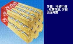 外露管道伸延至牙髓 外露管道伸延至牙髓