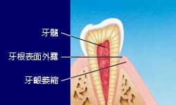 牙齦萎縮 牙齦萎縮